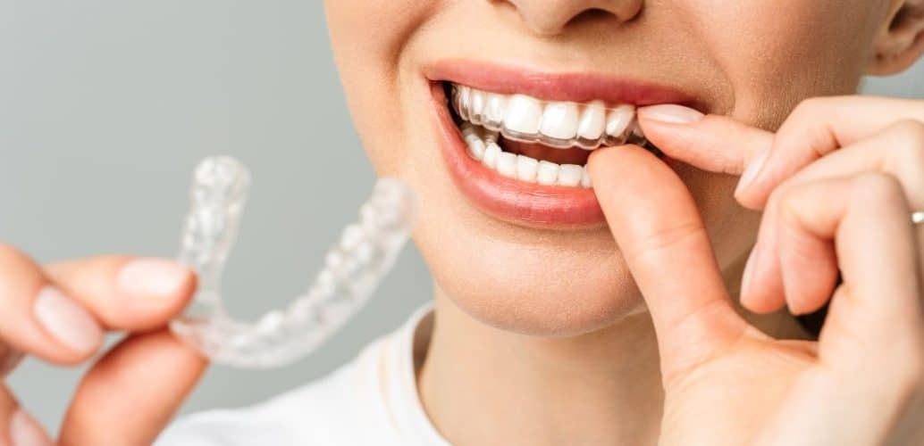 5 Major Benefits of Invisible Aligners - Baptist Road Dental